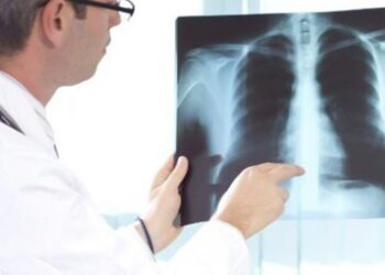 imagem de um médico olhando um raio-x de quem tem câncer de pulmão