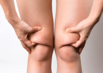 joelho com lipedema