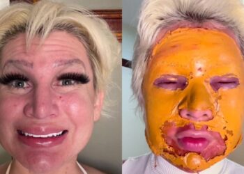 imagem mostra o antes e depois do procedimento com peeling de fenol da romagaga