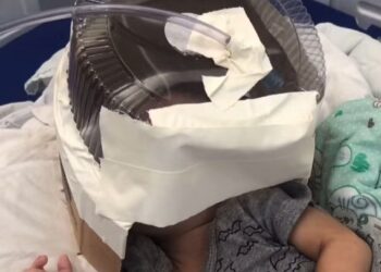Bebê de três meses foi submetido a uma intervenção incomum no hospital municipal de Santa Cruz, RN